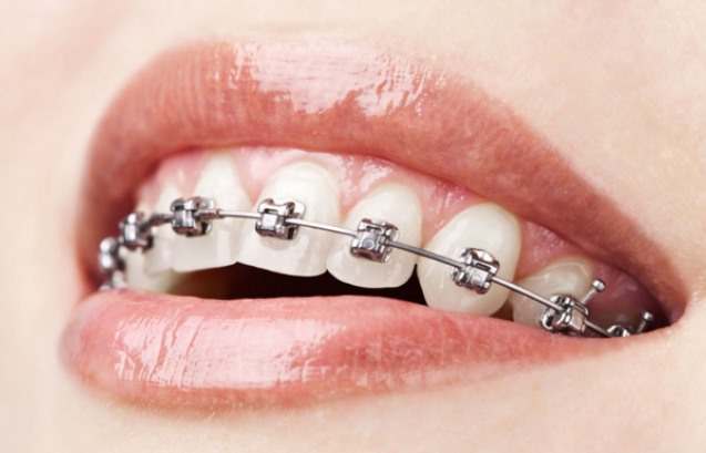 带牙套的最佳年龄(牙齿矫正：选择适合的年龄进行牙套治疗)