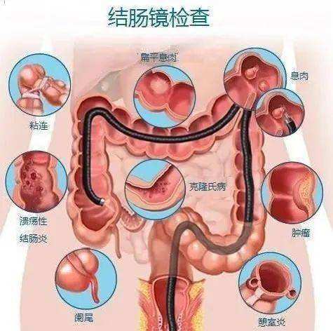 肠镜四种不能做的人（指明哪些人群不适合进行肠镜检查）