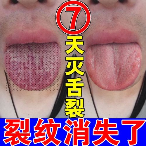 舌头裂缝是什么病（解析舌头裂缝的病因和治疗方法）