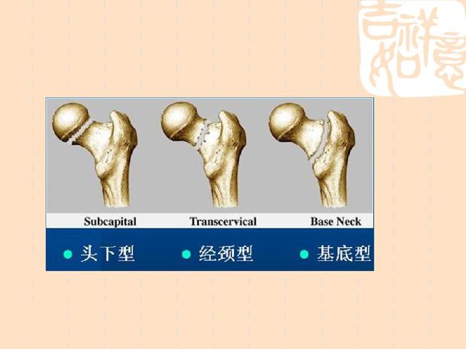 股骨颈是哪个部位（股骨颈位于股骨与髋关节之间，是常见的骨折部位）
