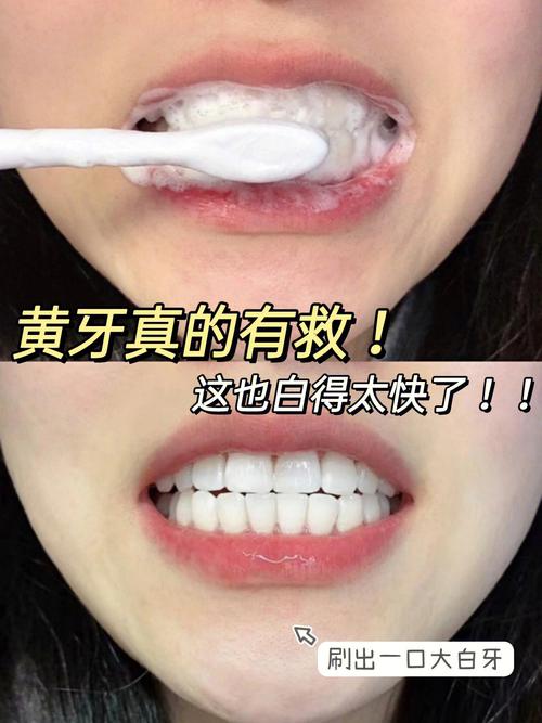 牙齿上有黑渍怎么去除（去除牙渍的有效方法与注意事项）