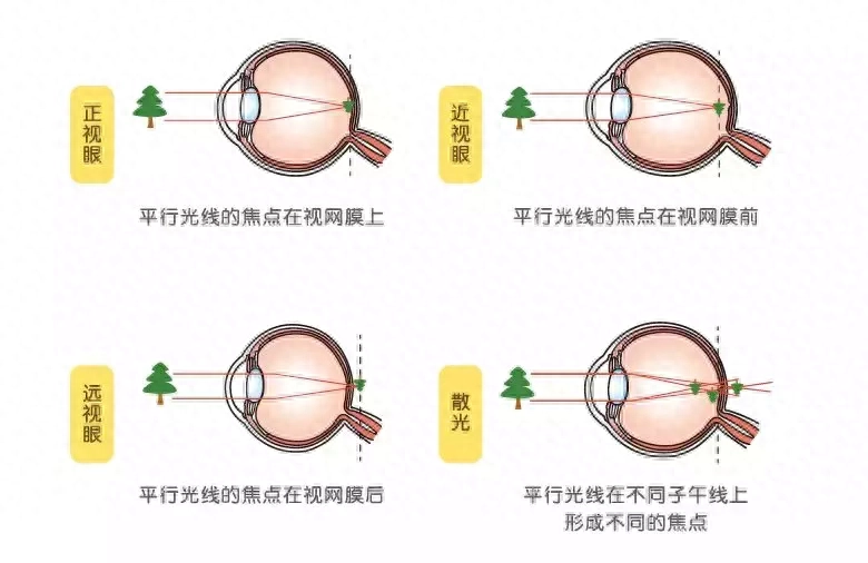 屈光不正和近视眼的区别是什么（近视和屈光不正不是一回事）